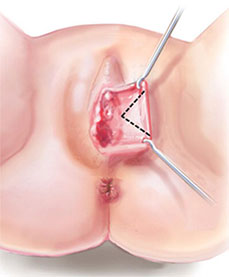 Labiaplasty - Technical triangular resection or V